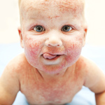 ECZEMA