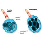 EMPHYSEMA