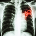 PULMONARY FIBROSIS