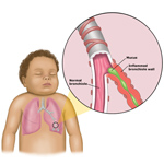 bronchiolitis_child